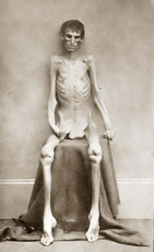Starving prisoner in the U.S. Civil War